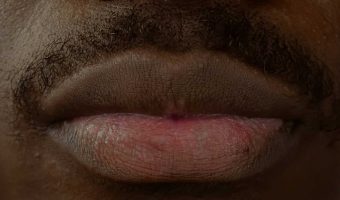 Advanced-Dermal-Fillers-Elevating-the-Oral-Commissures-Refresher-Course--best-you-training-2024