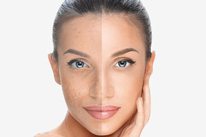 Chemical-Peels-Best-You-Training-Courses