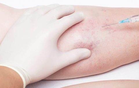 Microsclerotherapy Course