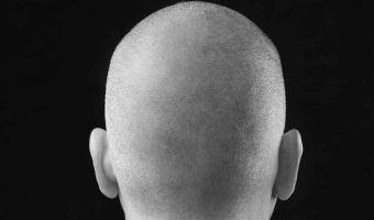 Scalp-Micropigmentation