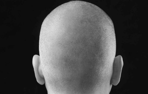 Scalp-Micropigmentation