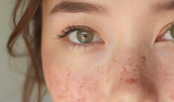 Skin-Inflamation-Course--Best-You-Training