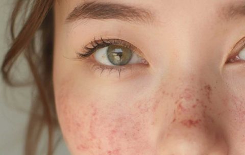 Skin-Inflamation-Course--Best-You-Training